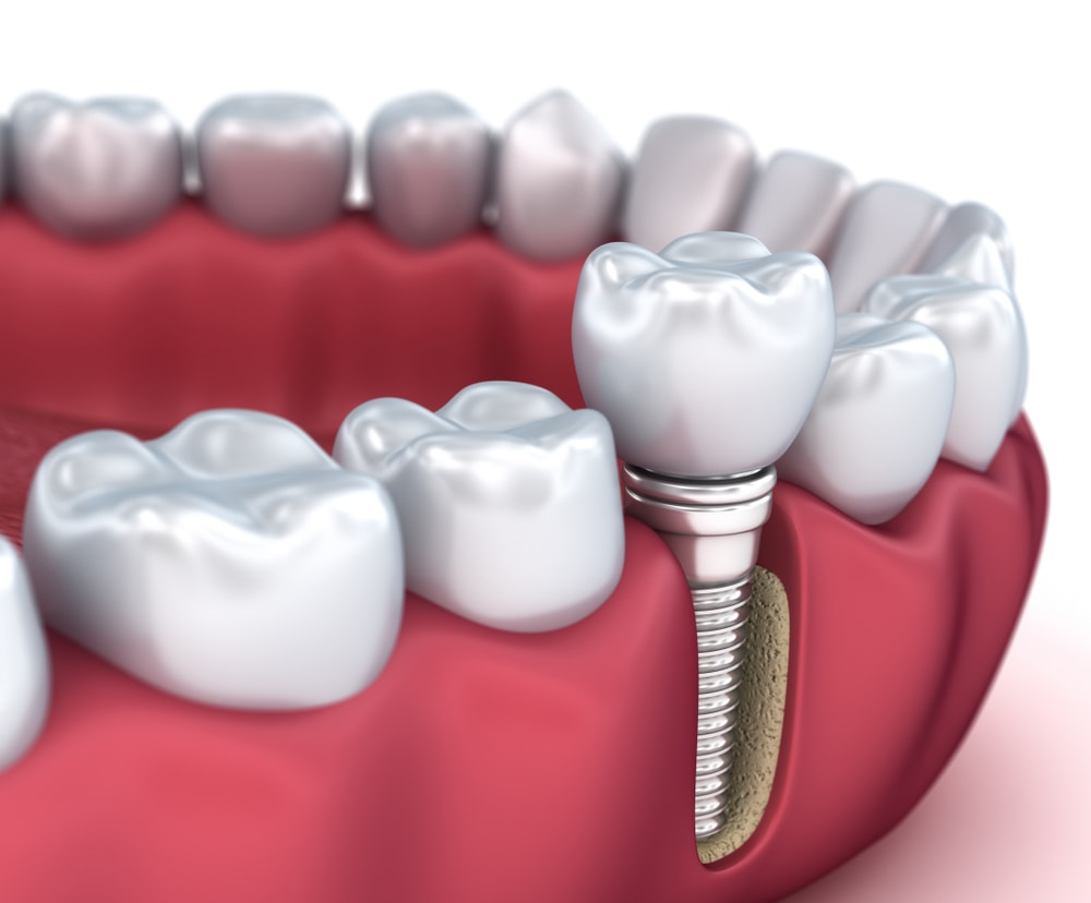 Les implants dentaires sont efficaces pour remplacer des dents